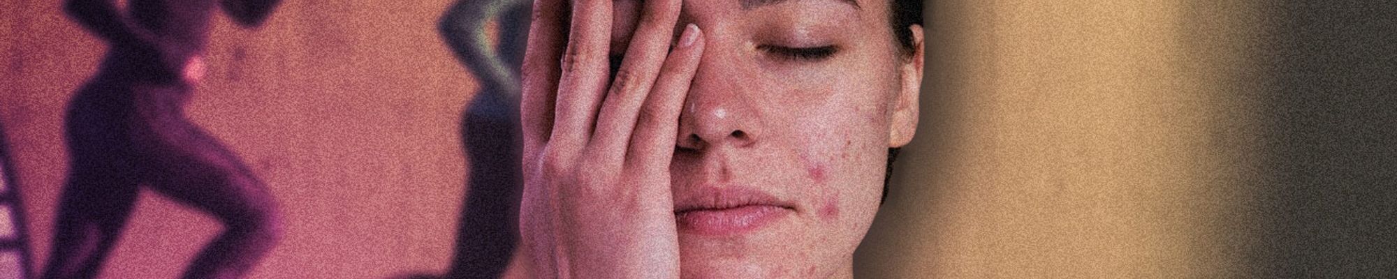 PCOS a hyperandrogenizmus: Ktoré doplnky výživy majú zmysel (+ praktická tabuľka)