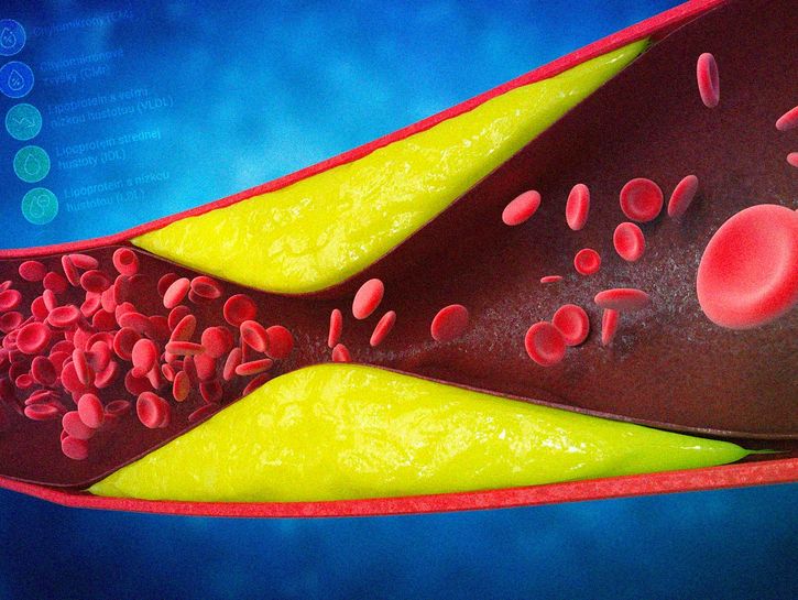 Cholesterol, lipidy a lipoproteíny: Ako ovplyvňujú naše srdce a cievy? (1. časť)